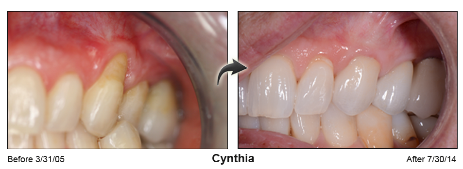 Palm Beach FL gum rejuvenation