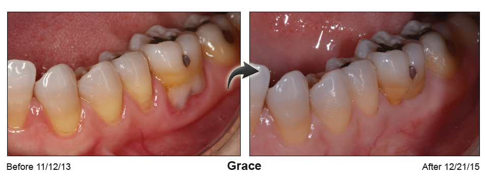 fix gum recession Palm Beach FL