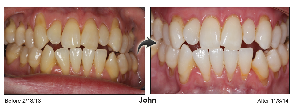 Palm Beach FL gum recession