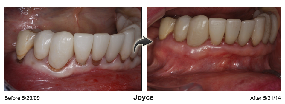 pinhole gum rejuvenation Palm Beach FL