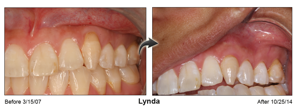 Palm Beach FL lunchtime gumlift dentist