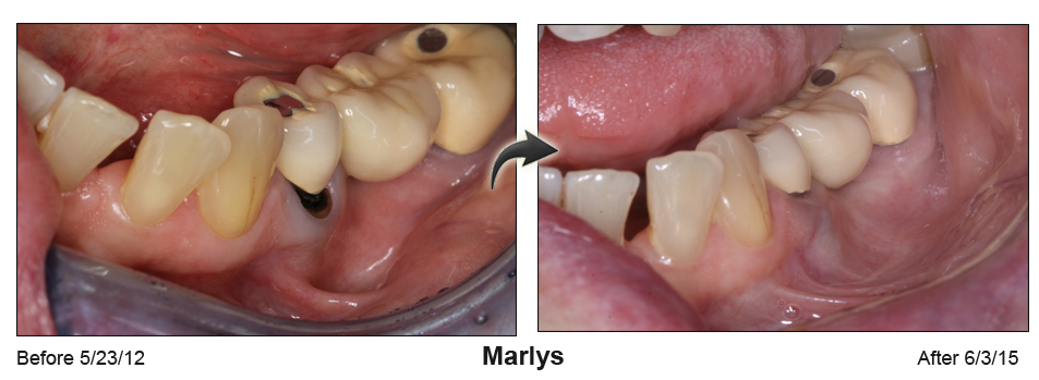 pinhole surgical technique dentist Palm Beach FL