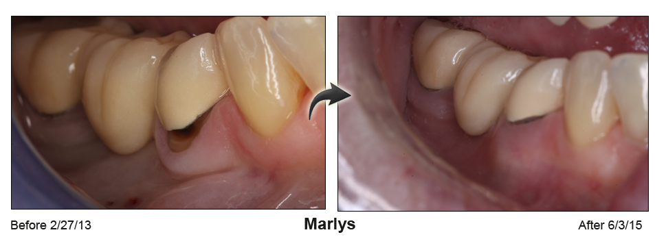 fix receding gums Palm Beach FL