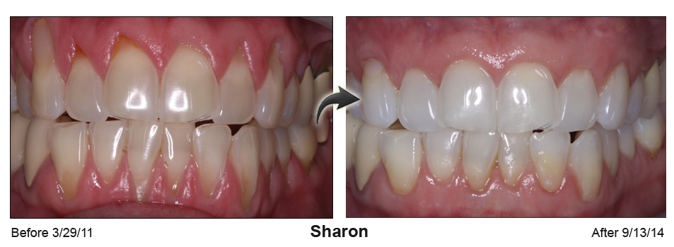 gum recession treatment Palm Beach FL