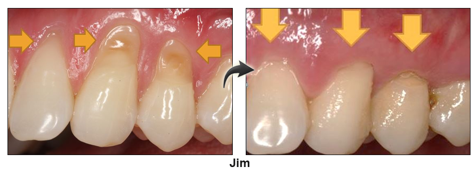 pinhole dental office palm beach